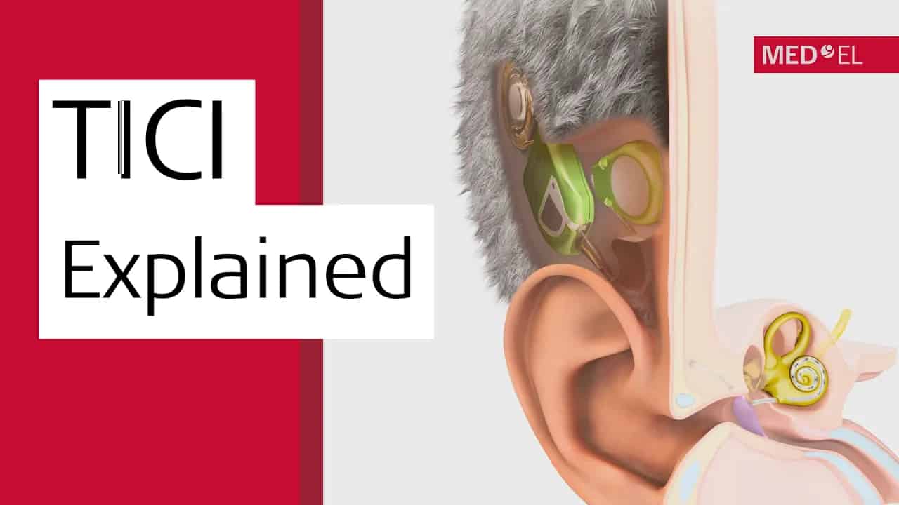 How Invisible Cochlear Implants Work | MED-EL TICI UNICO How Invisible Cochlear Implants Work | MED-EL TICI UNICO